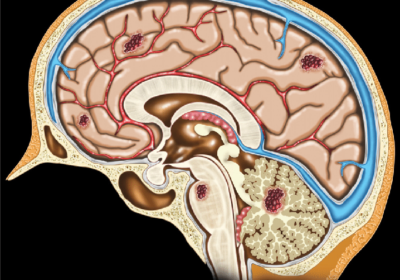 What is brain cavernoma and its causes?
