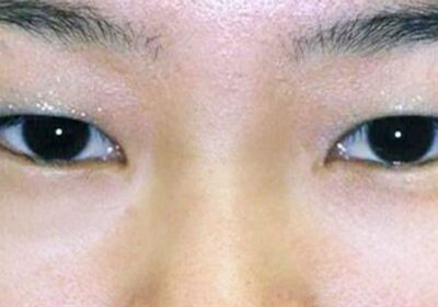 Redefining Your Eyes With The Help Double Eye Lid Surgery, For Men