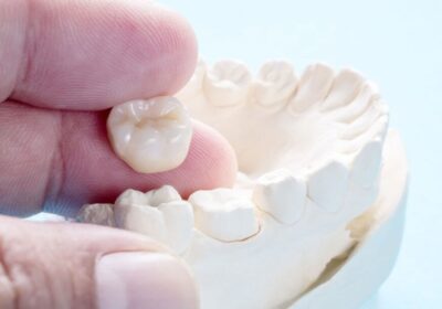Dental Crown: Procedure and cost