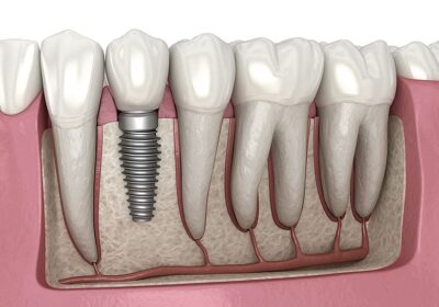 Mini Dental Implants- How to Maintain Them?