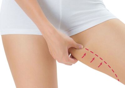 Thigh Lift Surgery in Turkey: High-Quality Cosmetic Procedures at Competitive Prices