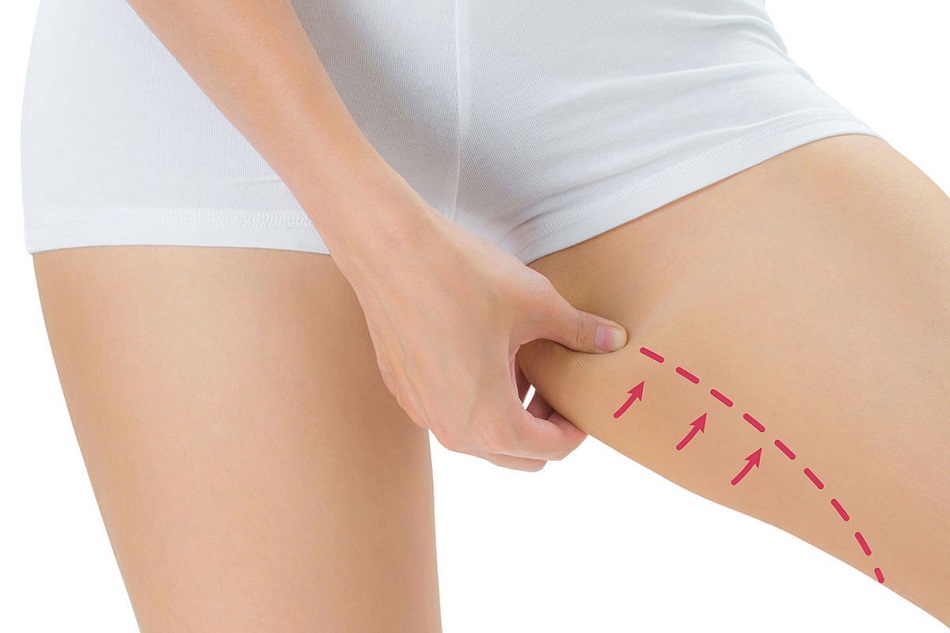 Thigh Lift Surgery in Turkey